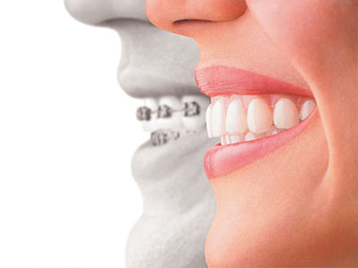 Invisalign vs Braces in Lewisville