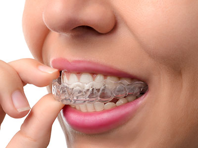 Invisalign Lewisville