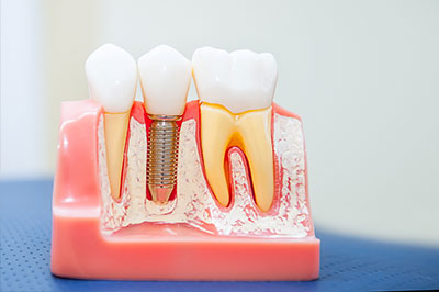 Dental Implants in Lewisville