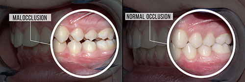 Lewisville Malocclusion