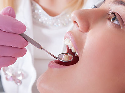 Dental Fillings in Lewisville